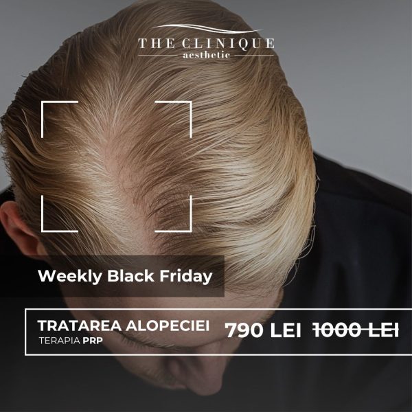 Tratarea Alopeciei - Terapia PRP
