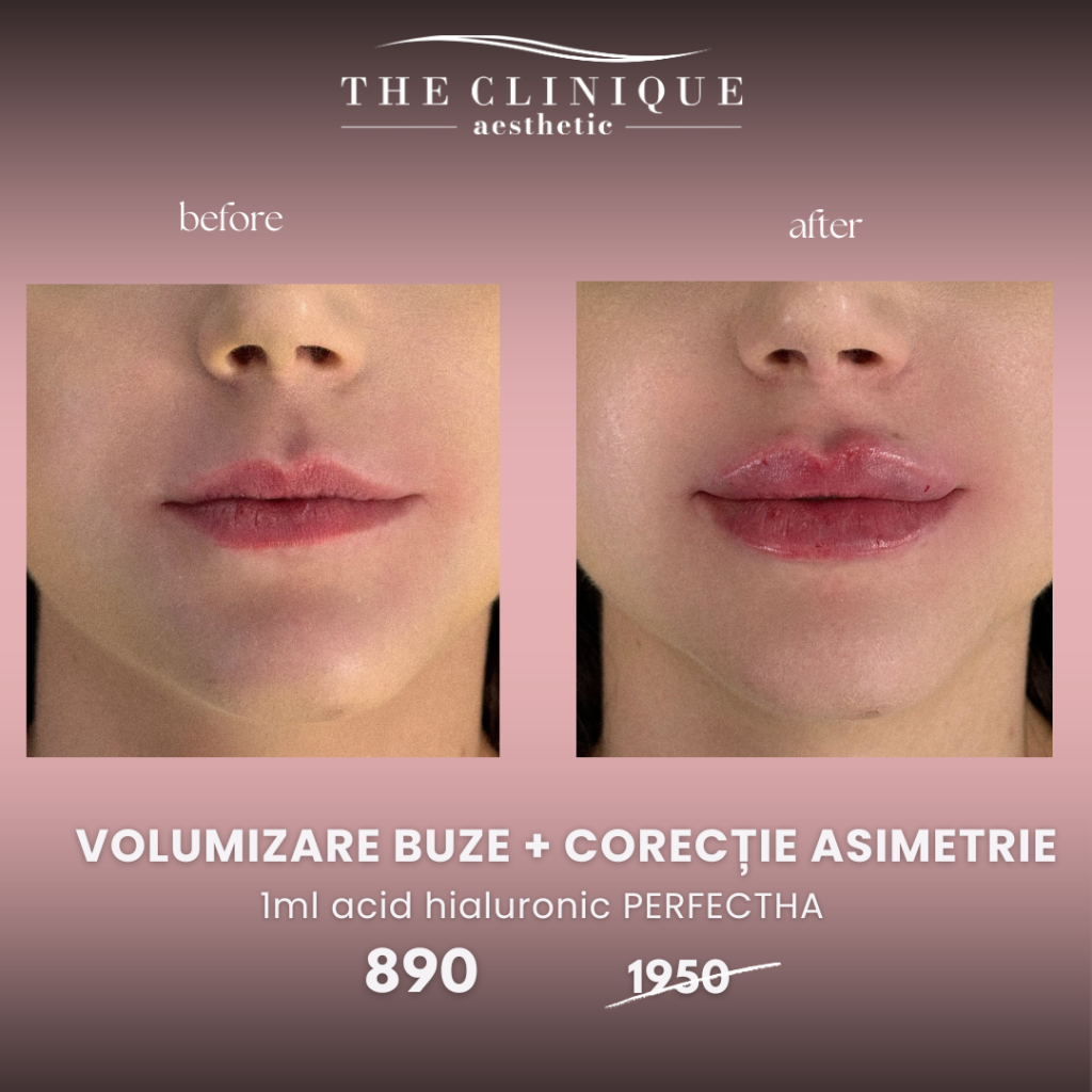 Volumizare Buze + Corecție Asimetrie