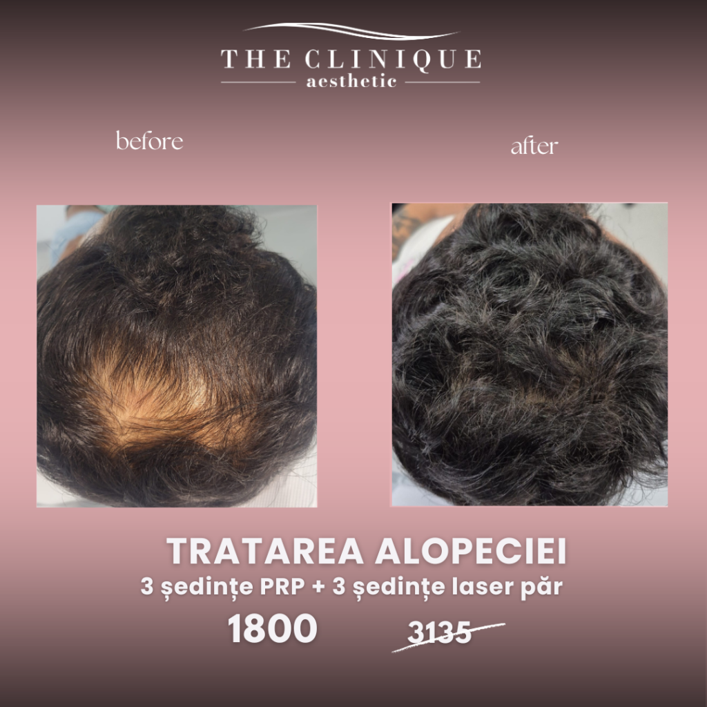 PRP Tratarea Alopeciei Barbati