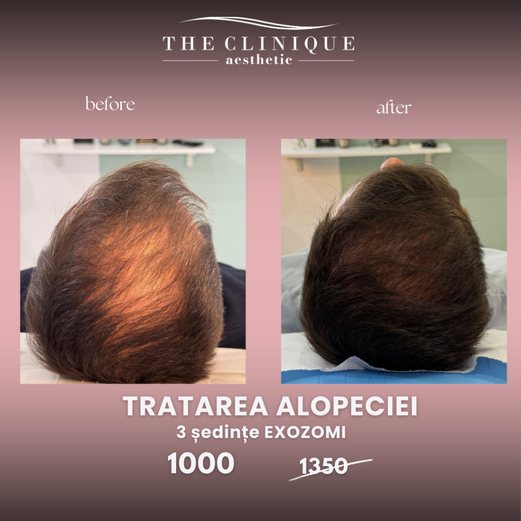 Tratarea Alopeciei - Exozomi 3 Sedințe