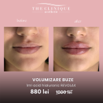 Volumizare Buze
