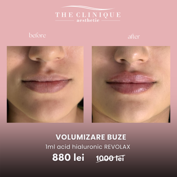 Volumizare Buze