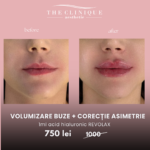 Volumizare buze cu Revolax