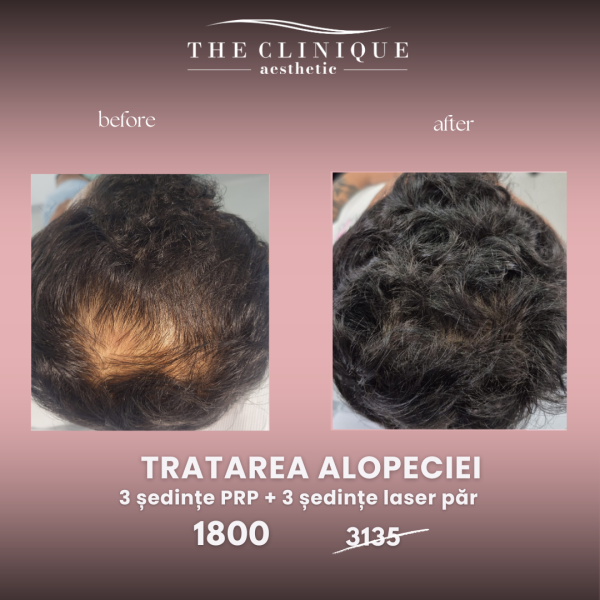 Tratarea Alopeciei - PRP