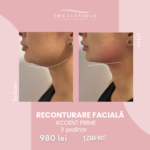Reconturare faciala Accent Prime (3 Ședințe)