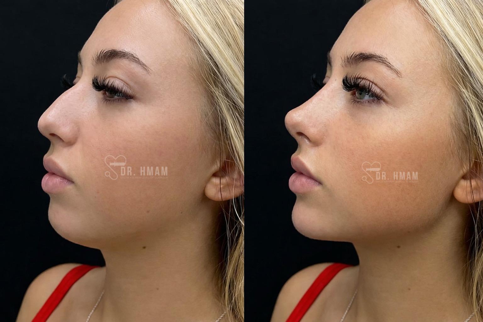 Rezultat Dr Hmam Rinoplastie