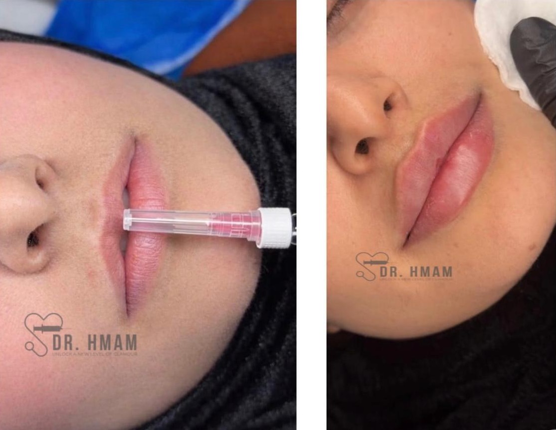 Rezultat Dr Hmam Russian Lips
