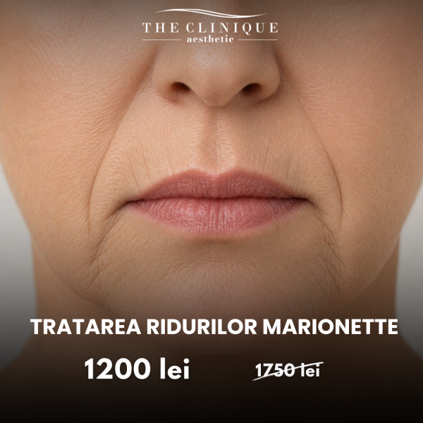 Tratare RIDURI MARIONETTE