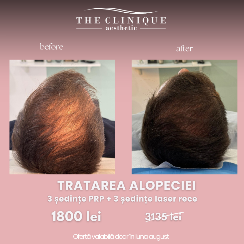 Tratament Alopecie: Pachet 3 Ședințe PRP