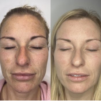 CO2-skin-rejuvination.jpeg CO2-skin-rejuvination.jpeg