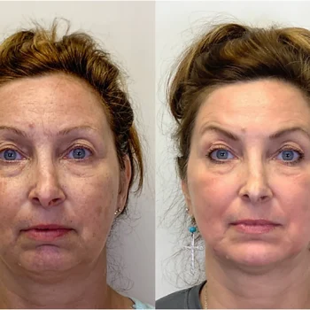 co2-laser-resurfacing-before-and-after-rewind-the-clock.webp co2-laser-resurfacing-before-and-after-rewind-the-clock.webp